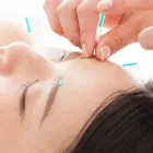 美顔鍼